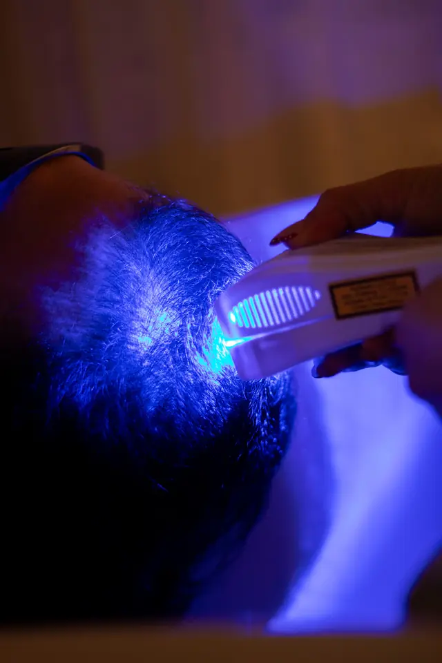 Sesión de terapia de luz azul sobre el cuero cabelludo.